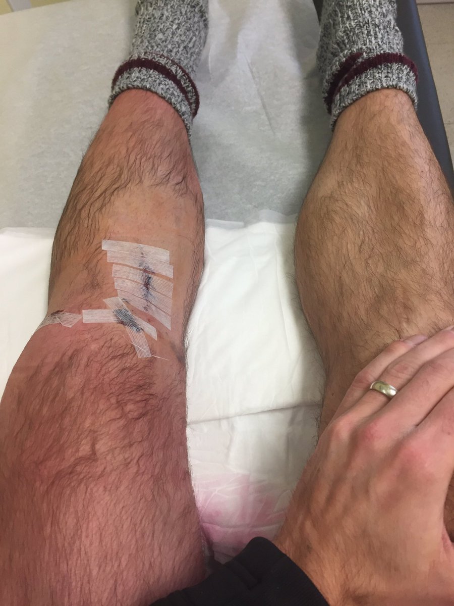 C_NODZ's tweet photo. A matching set! Now I have more time to follow @ProFootballDoc & @ACLrecoveryCLUB while I attack this rehab and get back to sport. #ACLx2 https://t.co/QHeA8Gj0Yz