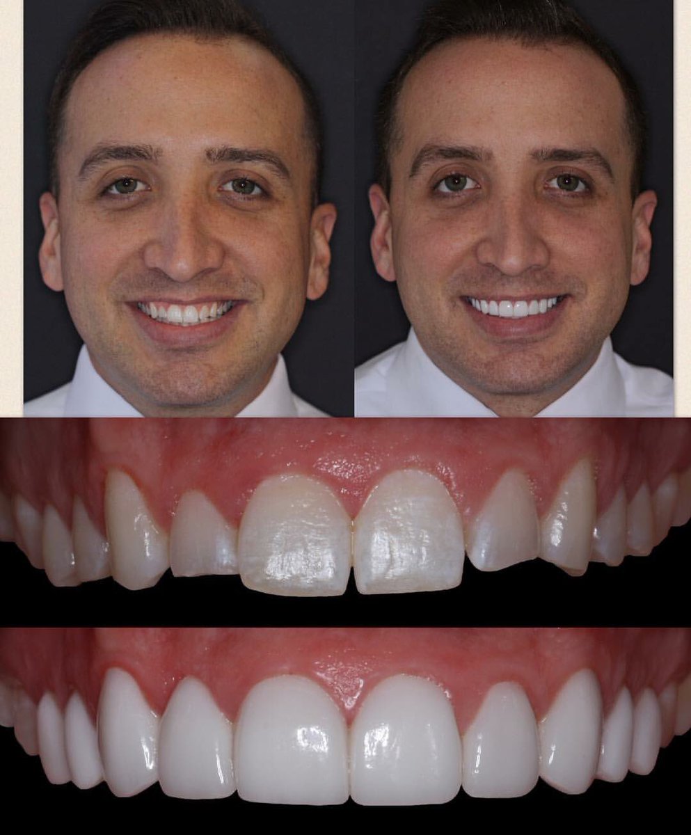 drandrewjkeller's tweet photo. Bellevue Dentists Dr. Beau and Andrew Keller of Da Vinci Dental. No drill veneers/lumineers https://t.co/jfOc4iTKDZ https://t.co/BsF5OvQWjg