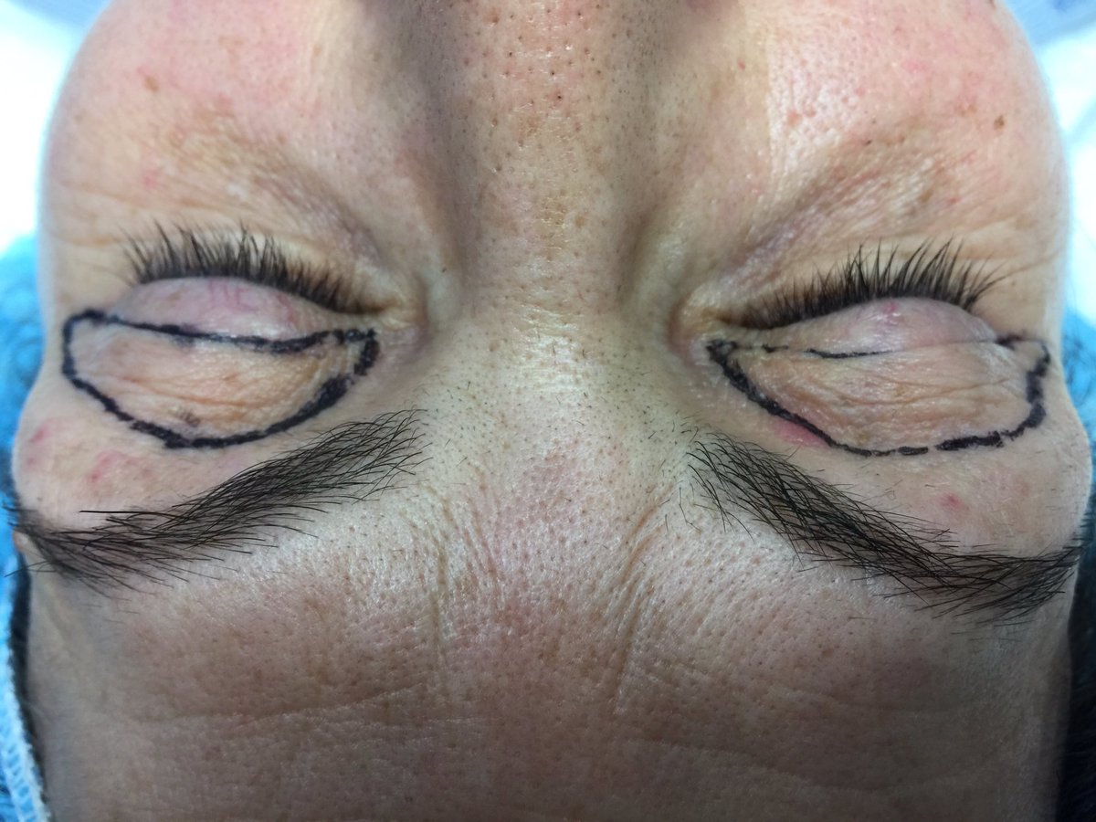 dr_seanrice's tweet photo. Eyelid #blepharoplasty #surgery today https://t.co/6DSFuOk27O