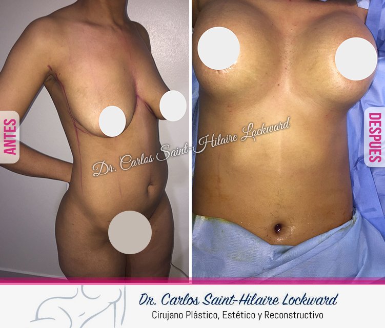 ¡Muñeca a la vista! Resultado de Levantamiento y mamoplastia de aumento.. Contáctanos, WhatsApp 849-919-3655 #DrCarlosSaintHilaireLockward