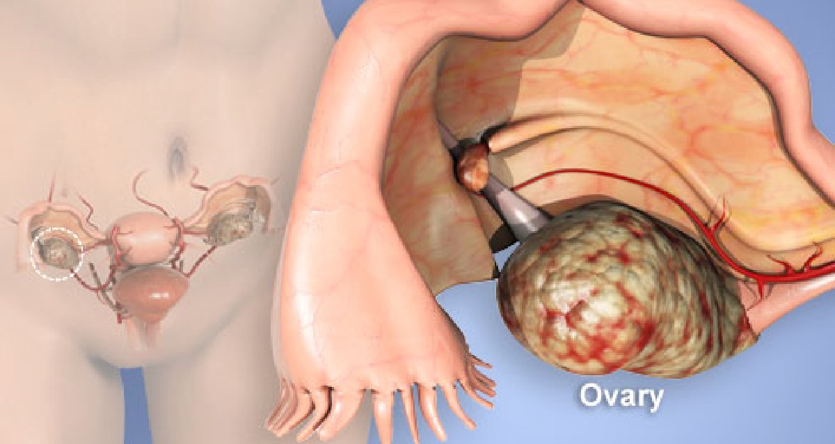 WebMD's tweet photo. Research has found that there are 4 main symptoms of ovarian cancer. What you need to know: https://t.co/iNr3fjzid3 https://t.co/i1jc9IG5yw