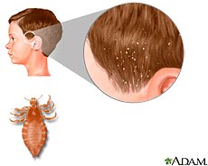 MissHenckels's tweet photo. Dealing Naturally with Head Lice #MissHenckels https://t.co/HVPau37y6j https://t.co/CFEWtMqgtl