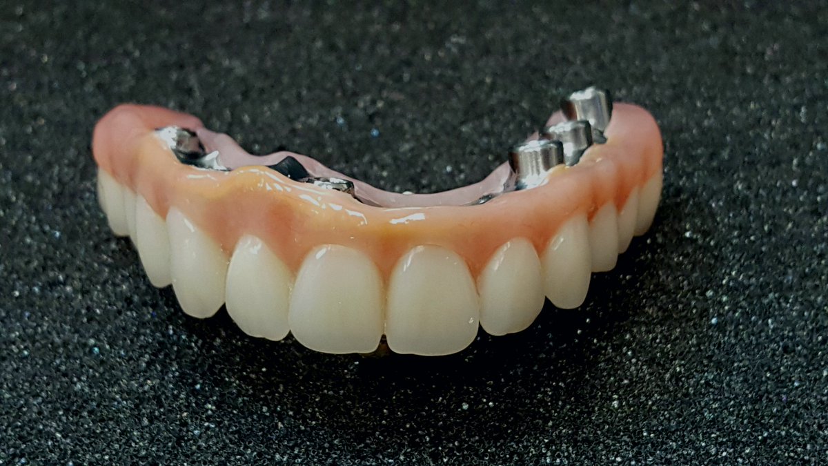 Shaunns_Dental's tweet photo. Hybrid denture
#dentallab #Shaunnslab #dentalhealth #dentalart #dentistry #dentaloffice #dentalcare #dentalgram https://t.co/jK3Mpy67TS