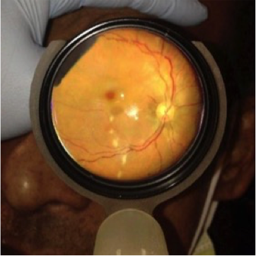 veranahealth's tweet photo. Guess that #pathology for #FundusFriday! Image taken with our #PaxosScope. #mhealth #eyecare #retinalimage https://t.co/pMNPk5EI41