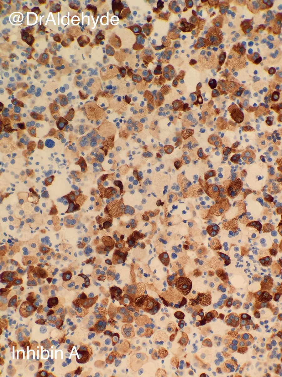 DrAldehyde's tweet photo. Adrenal cortical adenoma. Benign neplasm arising from adrenal cortical cells. #pathology #hartfordpath #adrenalgland https://t.co/C4jIcLvKUR