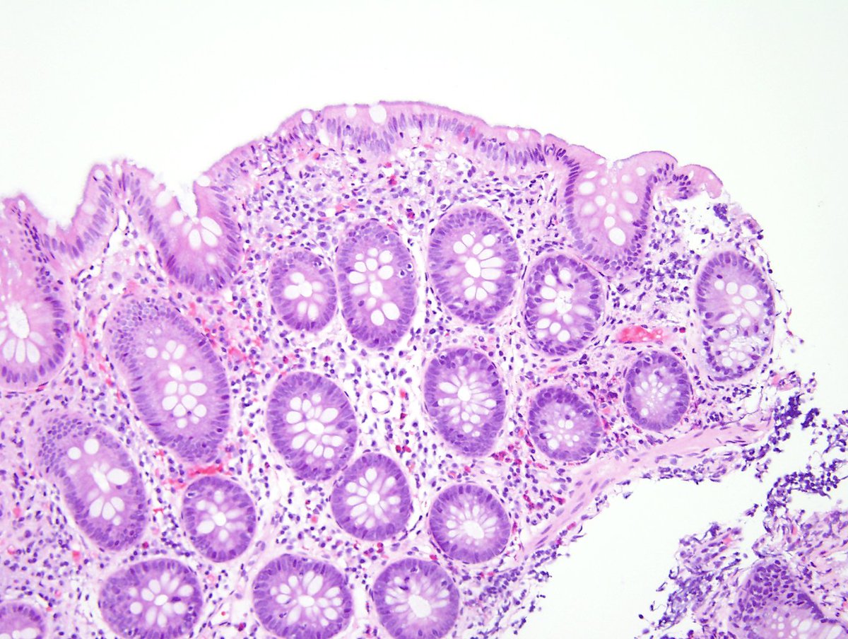 ARP_Press's tweet photo. Intestinal spirochetosis, often caused by Brachyspira aalborgi, is associated with diarrhea; organisms cross react with syphilis antibodies. https://t.co/NptjBSCZ7r