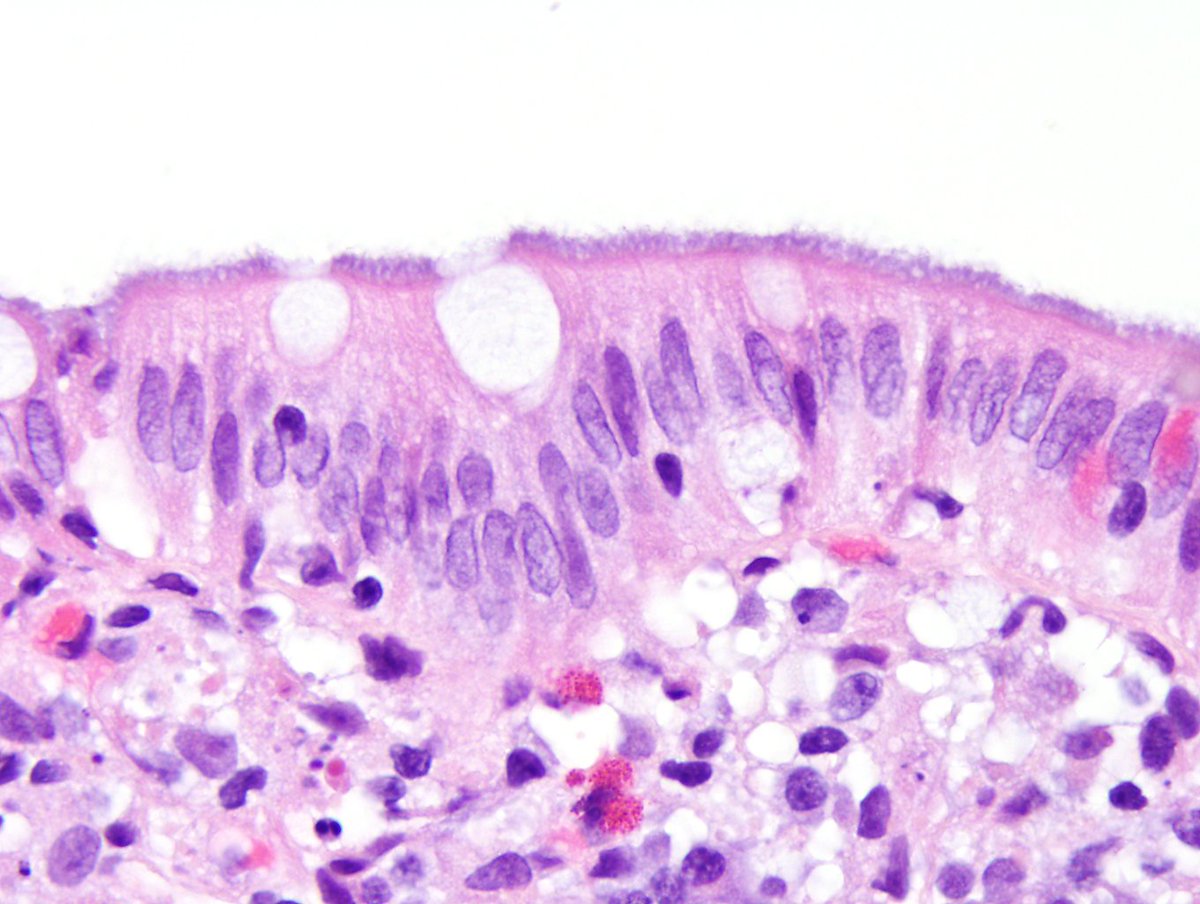 ARP_Press's tweet photo. Intestinal spirochetosis, often caused by Brachyspira aalborgi, is associated with diarrhea; organisms cross react with syphilis antibodies. https://t.co/NptjBSCZ7r