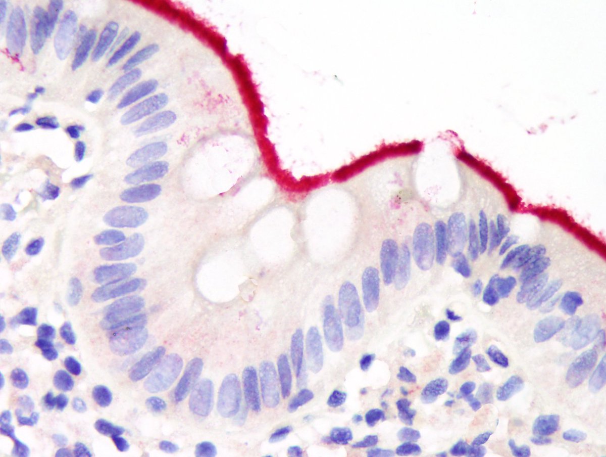 ARP_Press's tweet photo. Intestinal spirochetosis, often caused by Brachyspira aalborgi, is associated with diarrhea; organisms cross react with syphilis antibodies. https://t.co/NptjBSCZ7r
