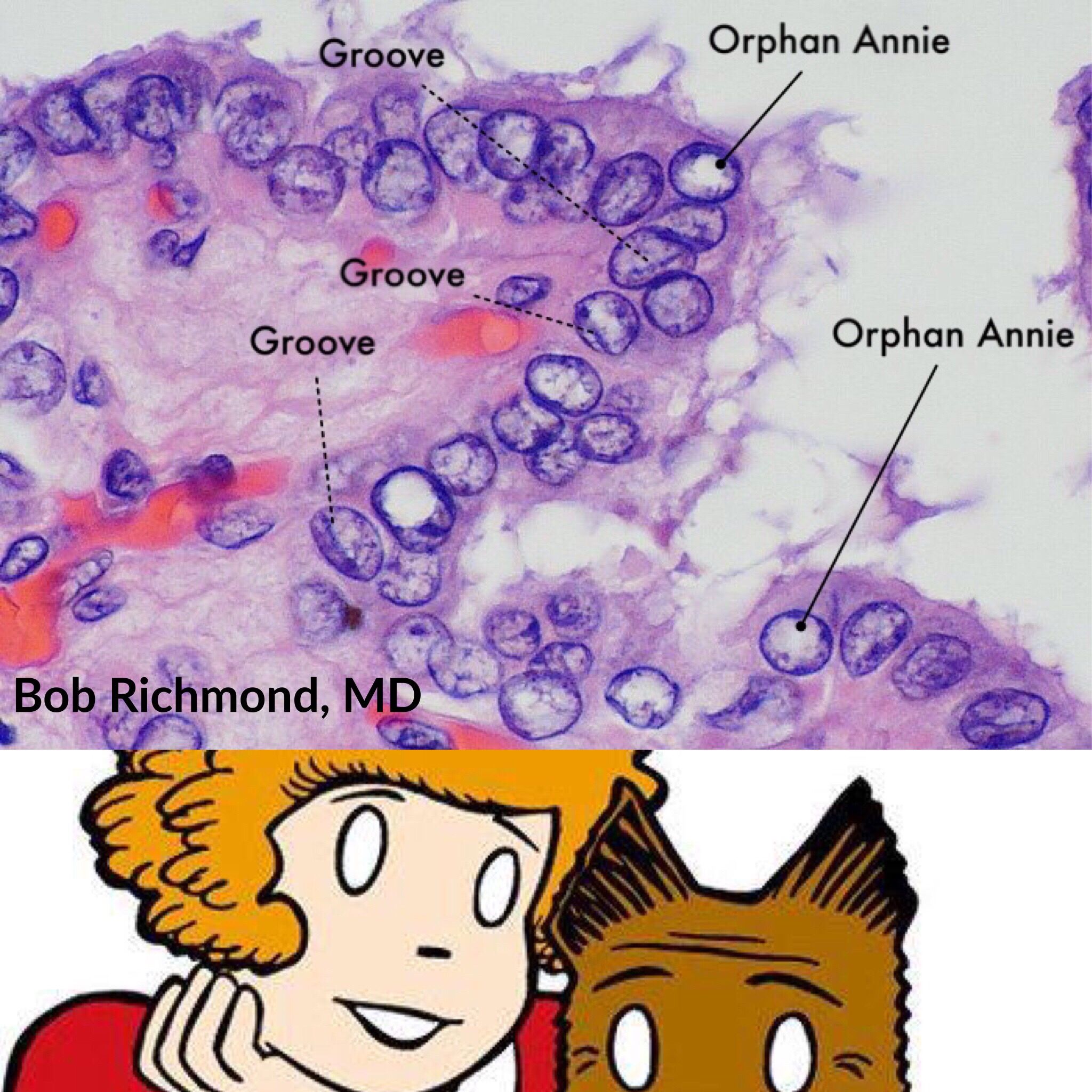 تويتر Jerad Gardner Md على تويتر Papillary Thyroid Carcinoma Grooves Amp Classic Orphan Annie Eye Empty Round Nuclei Here With Their Namesake Pathology Pathart Https T Co Pkbirrzotv