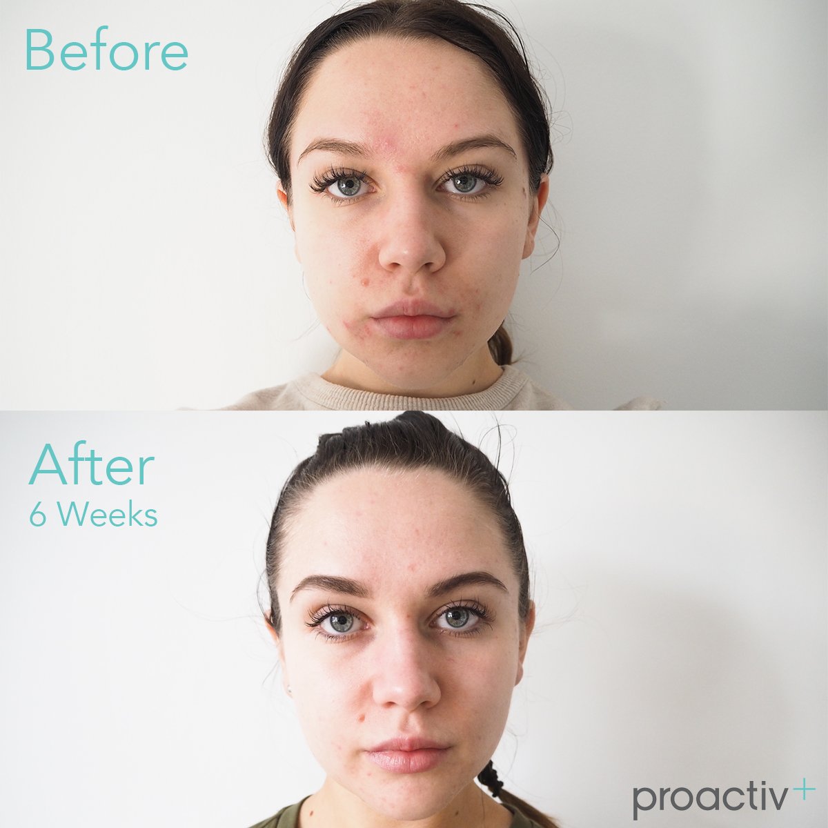 Proactiv_UK's tweet photo. An incredible result in just 6 weeks of using our 3-Step system! 
#Proactiv #ProactivPlus https://t.co/lEV9I4Kda0