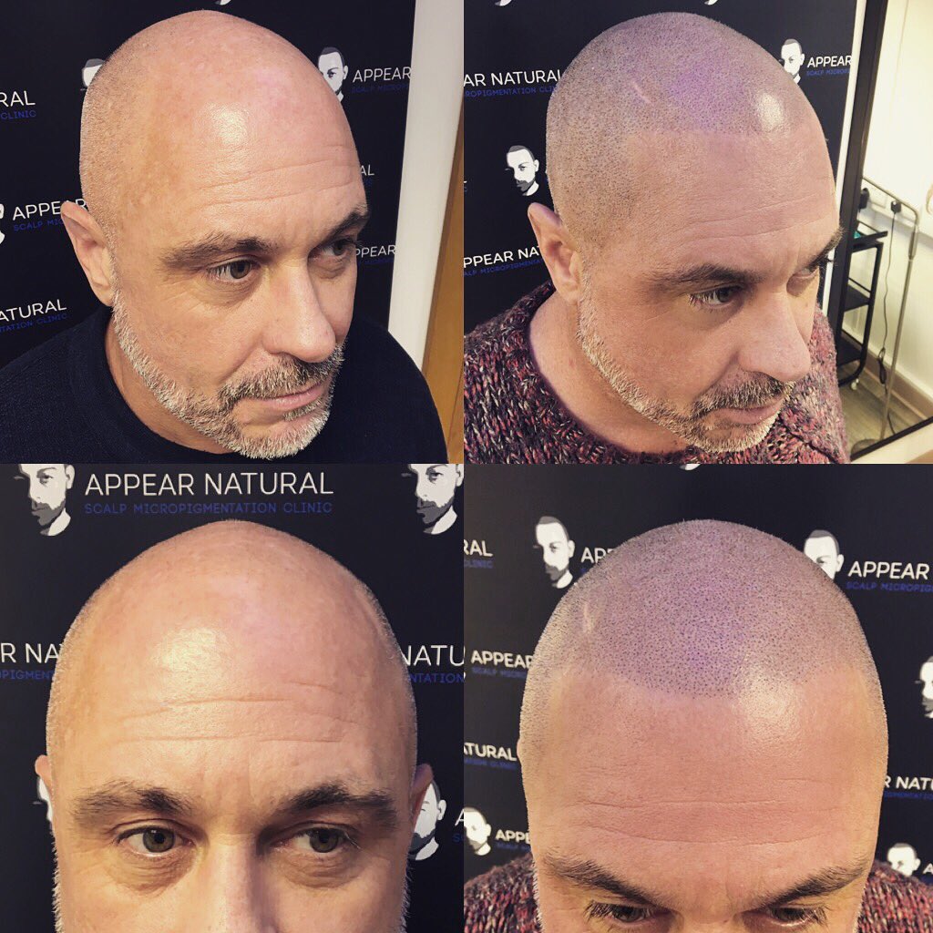 Ollie_Roses's tweet photo. Say goodbye to #hairloss ....... @BeckBromFL  @BromleyTimes @BromleyNow https://t.co/ZMZrHXuRvk