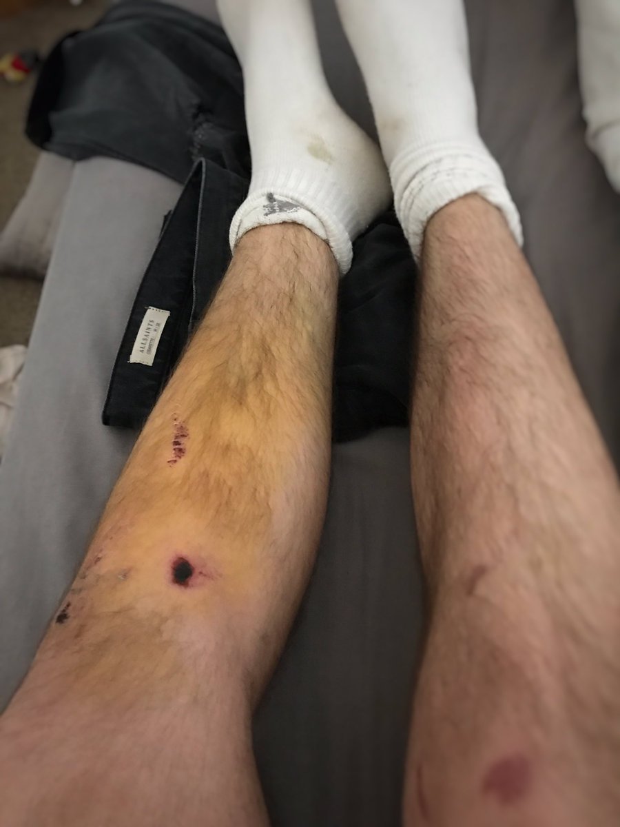 JaySwingler's tweet photo. alright so why does my bruised leg look like its trying to audition for the simpsons then https://t.co/bISZwPaKK8