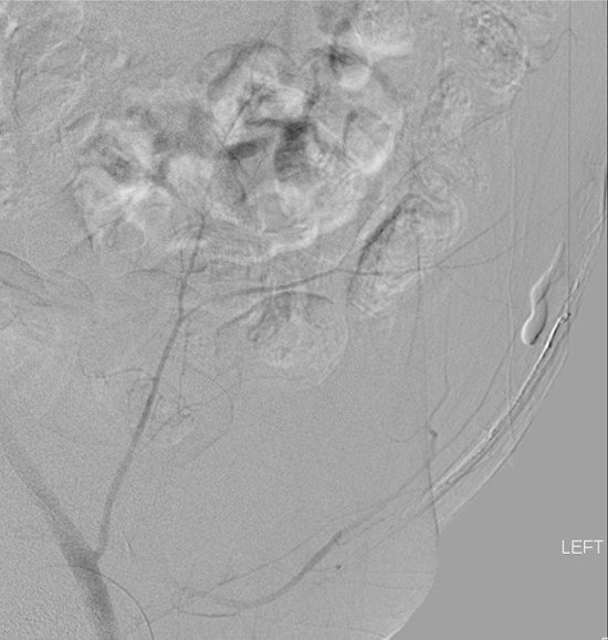 MUSCVIR's tweet photo. Transradial inf epigastric artery glue embolization for bleeding after paracentesis. #IRad https://t.co/OBAChf7Eel
