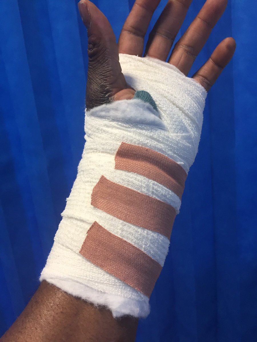 wegbe4's tweet image. Lister hospital well done #Carpel Tunnel operation