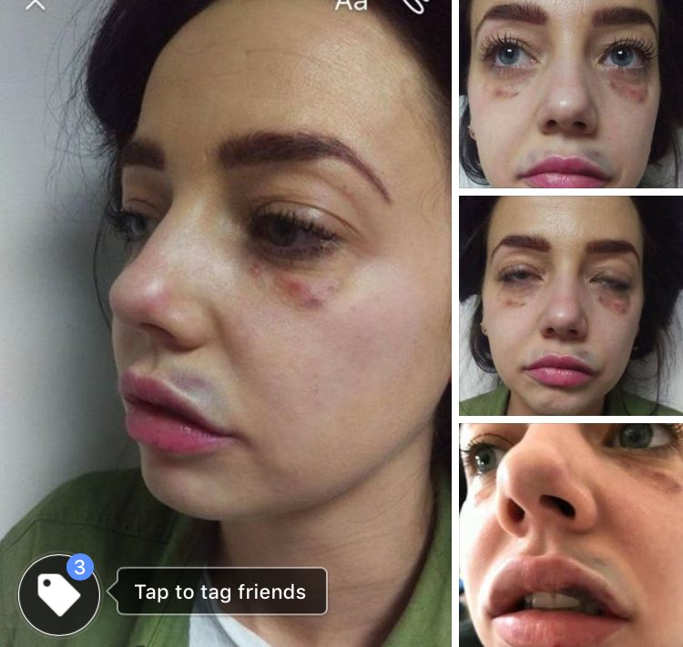 safetyinbeauty's tweet photo. The law on who can inject dermal cosmetic injections seriously needs to change and this is WHY! #safetyinbeauty #StopCosmeticCowboys https://t.co/4WkuXKIOve