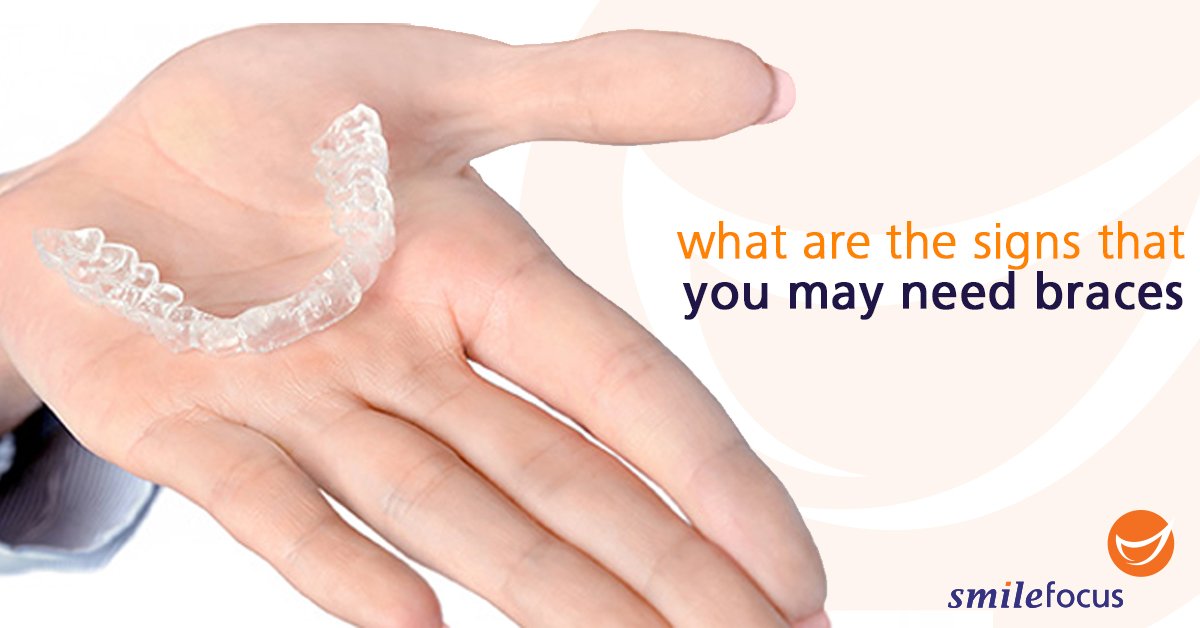 How do you know when you need braces? 
smilefocus.com.sg/what-are-the-s……
#smilefocus #orthodontics #crowdedteeth #braces