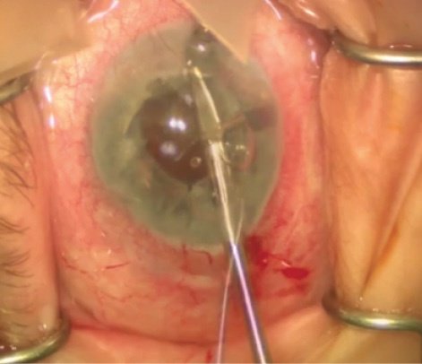 CRSToday's tweet photo. Don’t miss this unique video showing a complicated #IOLexchange: https://t.co/aJxc5gVDSj #Ophthalmology https://t.co/s9Vc8EBbaY
