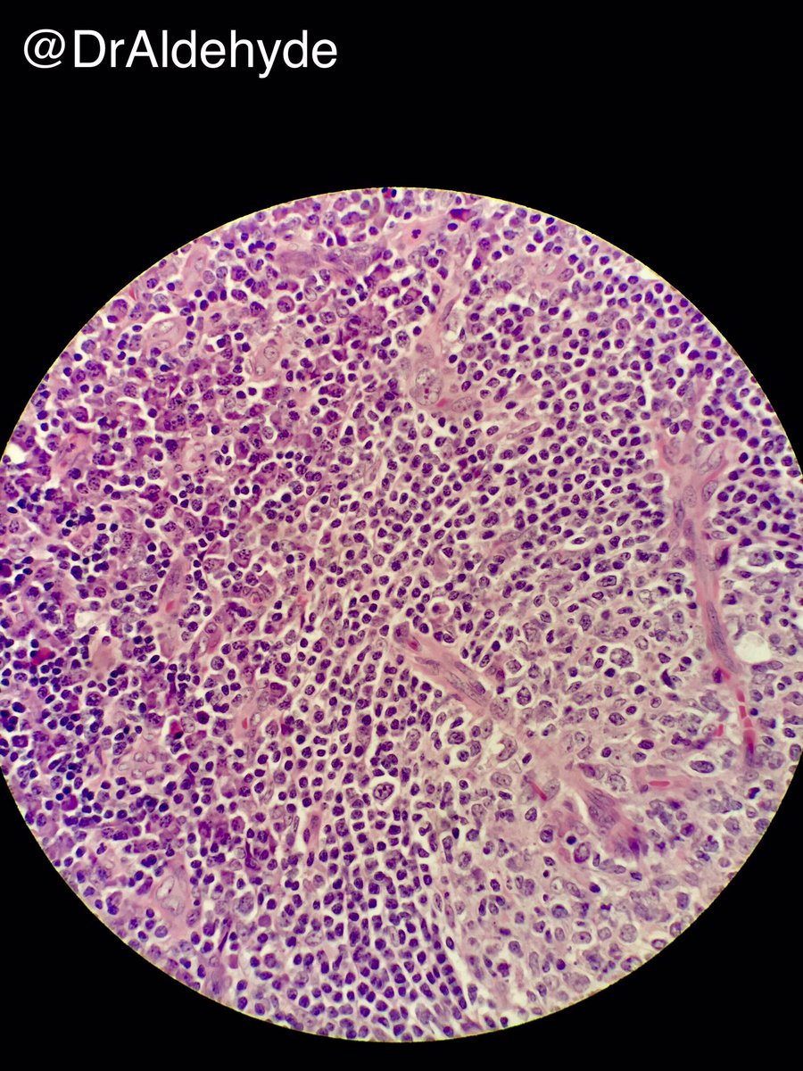 DrAldehyde's tweet photo. Plasma cell variant Castleman disease is often associated with #HHV8 infection. #pathology #hemepath #onionskin #hartfordpath π¬πππ https://t.co/GmNsO8UeJq