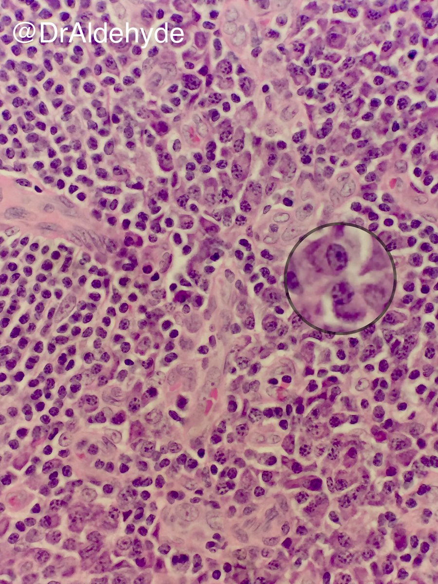 DrAldehyde's tweet photo. Plasma cell variant Castleman disease is often associated with #HHV8 infection. #pathology #hemepath #onionskin #hartfordpath π¬πππ https://t.co/GmNsO8UeJq