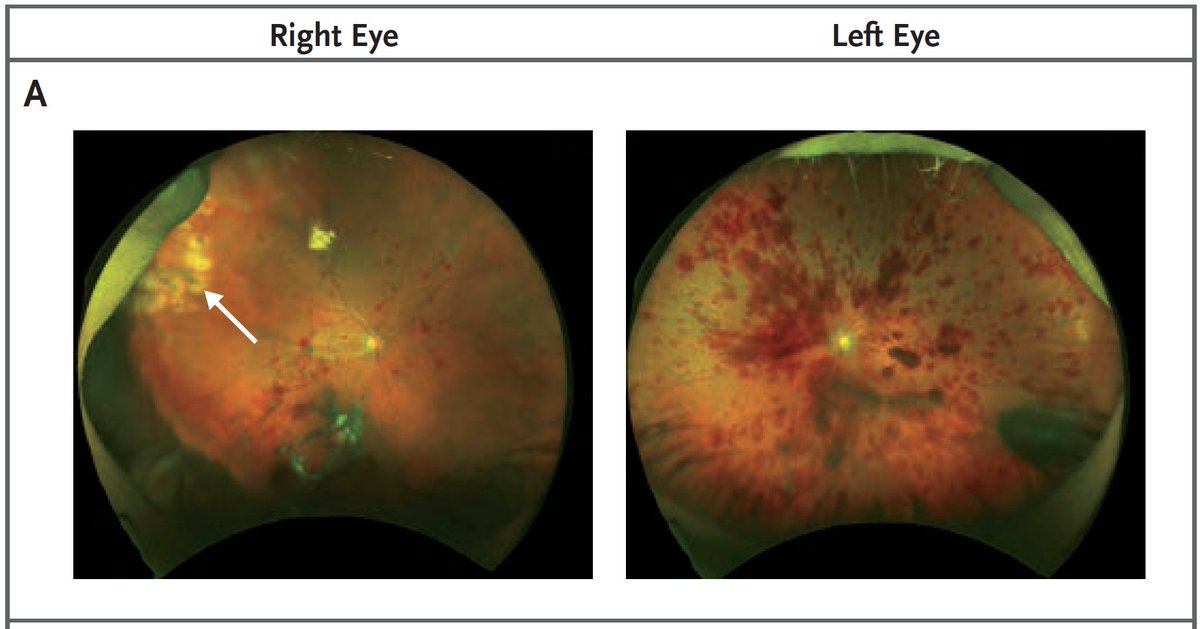 eyesteve's tweet photo. Stem Cells and Treatment of Eye Disease: A Cautionary Tale
https://t.co/S6YSImvULL via @MattWeedMD #stemcells #research https://t.co/9O8RdjMTxT