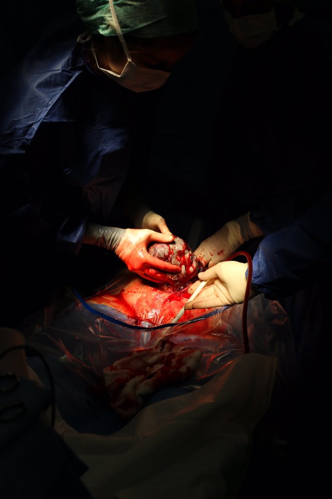 My new documentary called Cutting the cord all about the <a href="/AneurinBevanUHB/">Aneurin Bevan University Health Board</a> maternity  departments coming soon #NHSwales #maternity #document