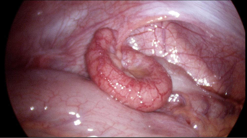 Variation +++ USA vs UK appendicitis.  Is lap appy associated with better outcomes?   ncbi.nlm.nih.gov/pubmed/28299474  <a href="/RIFTaudit/">RIFT Audit</a> <a href="/ravinder_vohra/">Ravinder Vohra</a>
