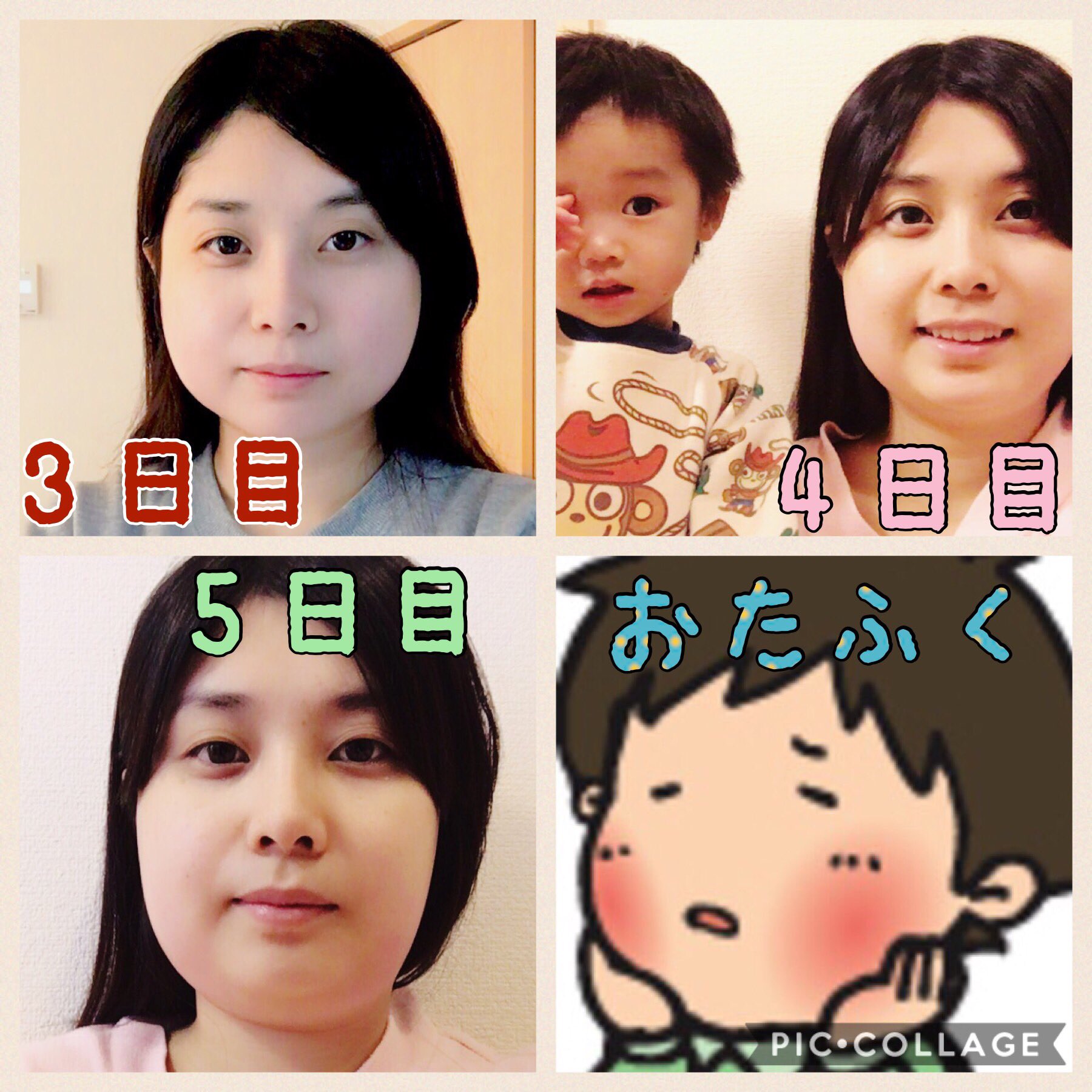 しらこ En Twitter 大人のおたふくはヤバいと言いますが本当にやばい 37度 39度を行ったり来たりで もちろん腫れも激痛で痛いの我慢して食べてもその後強烈な痛みで食べるのを辞めました 左右差無いせいで病院行っても左右差もなくまだ腫れて無いし一応採血しよう