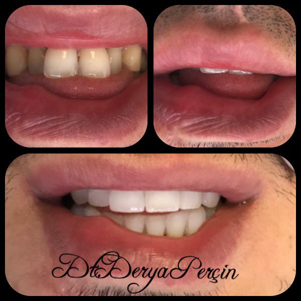 ~Hayatıma değer katan gülümseme~
Dt. Derya Perçin 05326427775 #smile #estetikdişhekimliği#beforeandafter  #zirkon #popular #dtderyaperçin