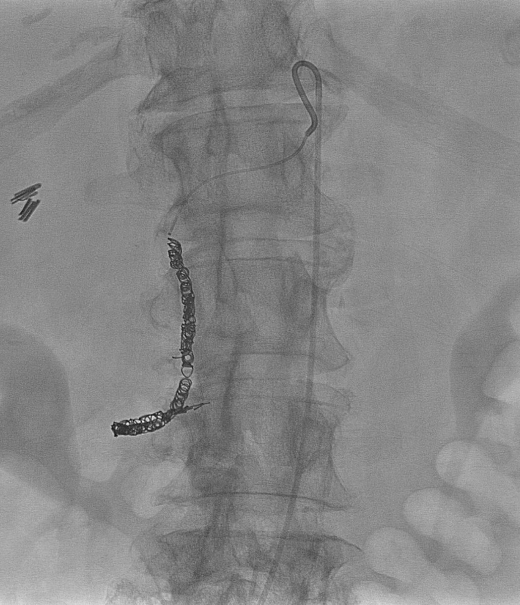 msran124's tweet photo. Quick little GDA embolization for bleeding duodenal ulcer #callnights #mtsinaiIR https://t.co/z6RdohNhQV