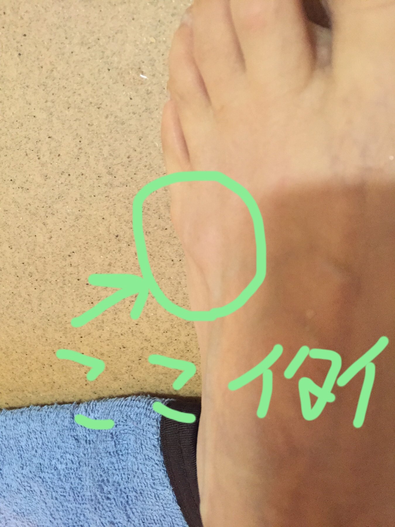 植松寿絵 Twitterissa 昨日 なんか足の甲がチクチク痛いなー って思ってみたら プクって膨らんでた シコリみたいに固くないの 血管膨らん出るみたいにパンパン でも内出血してないし プヨプヨパンパンしてるし 靴が当たると痛いし 病院行きたくても火曜日までやって 植松寿絵 Twitterissa 昨日 なんか足の甲がチクチク痛いなー って思ってみたら プクって膨らんでた シコリみたいに固くないの 血管膨らん出るみたいにパンパン でも内出血してないし プヨプヨパンパンしてるし 靴が当たると痛いし 病院行きたくても火曜日までやって