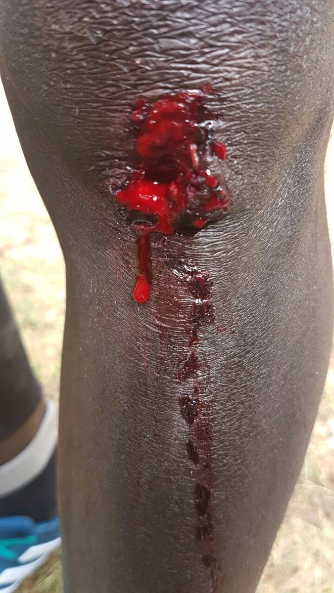 This is what happened some weeks ago. I feel down with my knee and it needed to be stitched. Scanning showed nothing damaged, but I.. (1/2)