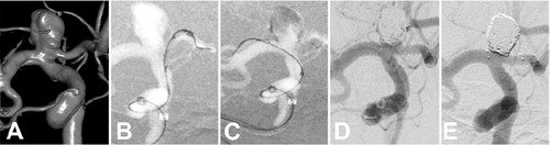 #OnlineFirst: The second-generation eCLIPs Endovascular Clip System: initial experience thejns.org/doi/abs/10.317…