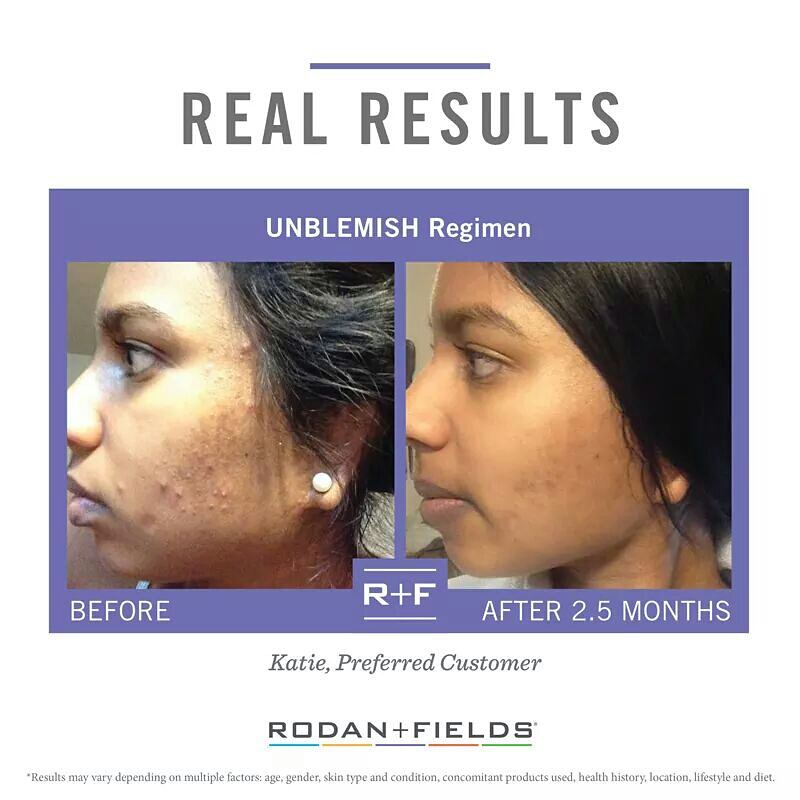 Acne-free skin is within reach! Message me for details. #rodanandfields #unblemish #selfcare #freshfaces #teamtenacity #consultant