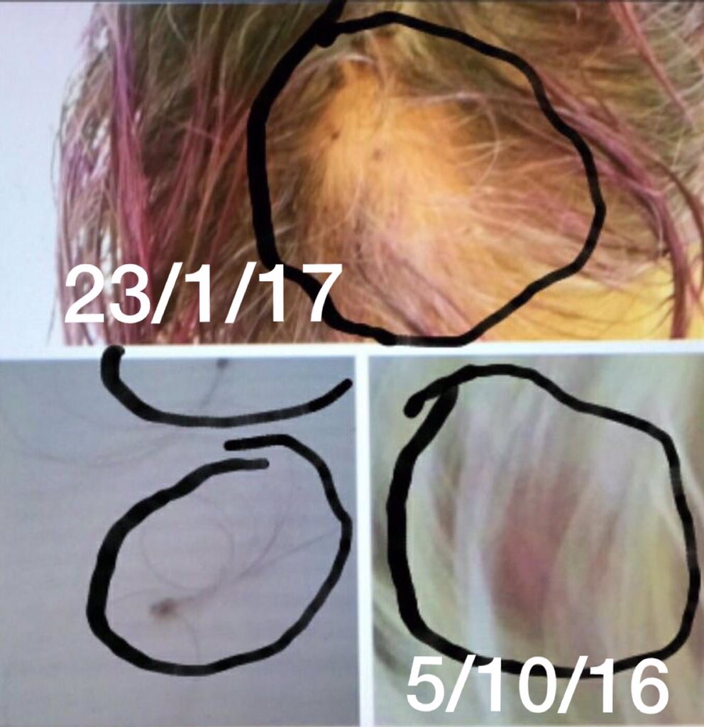 lluna422's tweet photo. @paquito_perez8 @DorannaHair así,el 5/10para q 👎🏻se te olvide me dejaste la cabeza #Quemada por tú mala #Praxis 🏦el daño hecho a @lluna422 🤕 https://t.co/Keke6pa1Jn