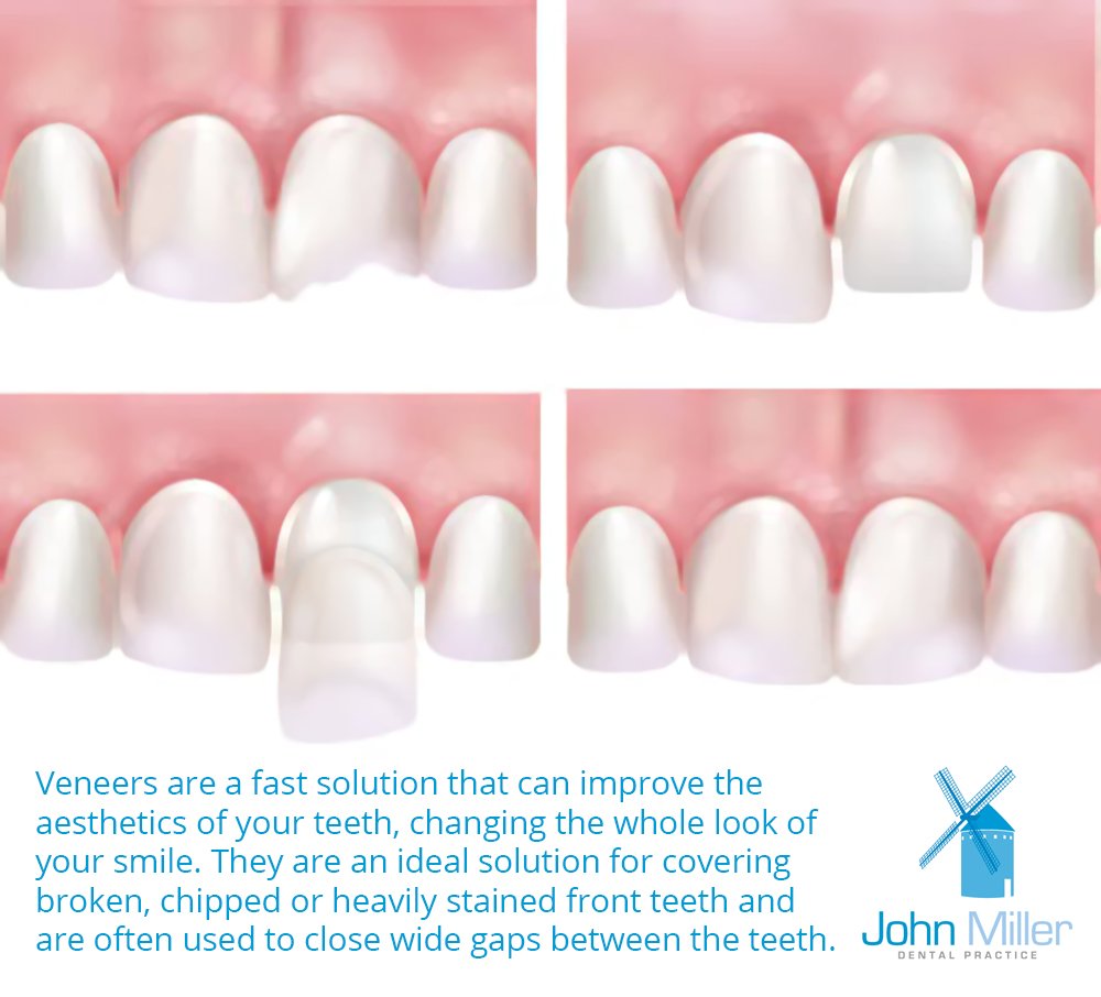 JohnMillerDent's tweet photo. Veneers can give you the perfect million-dollar smile you've always wanted. Find out more here - https://t.co/2tdKqZ9u8f https://t.co/9EclNv9GYY