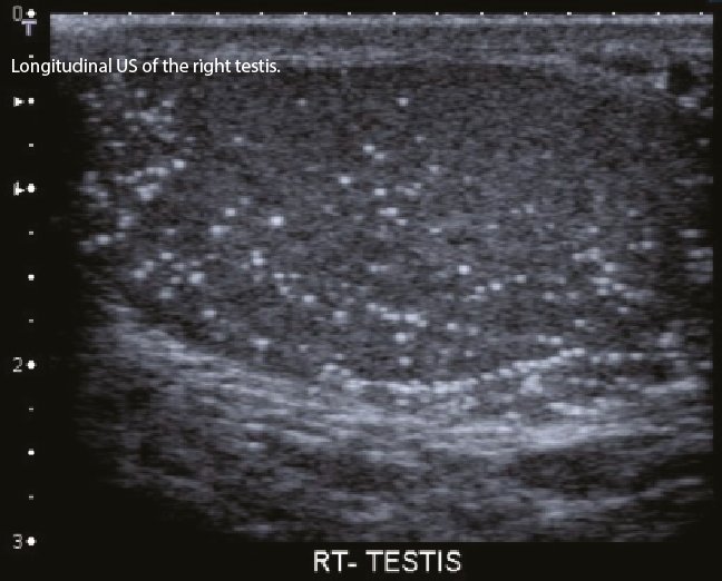 #Radiology quiz
Case 2 bit.ly/2ml73qX

2. What is the diagnosis?

#uronews #urology