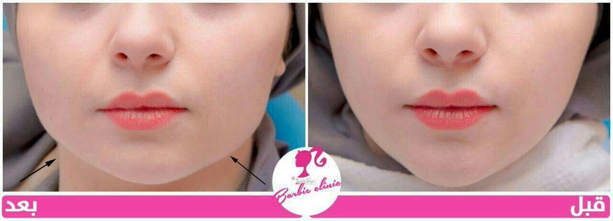 مركز باربي الطبي للتجميل والليزر:
#عروضنا_مستمرة
إحصلي على اطلالة النجوم مع #باربي
احدث تقنيات الحقن في #باربي فقط✌🏻️