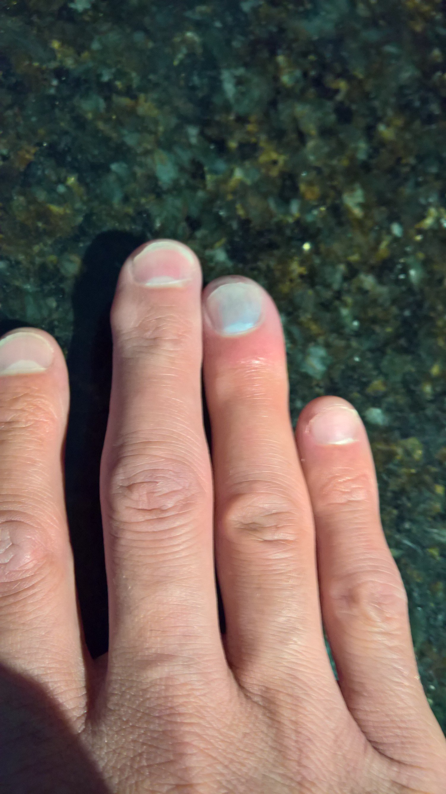 Parker Smart Taken Down By Infection Small Cut Under Fingernail On Monday Sore By Wednesday Throbbing Ball Of Puss By Sunday Fingerheartbeat T Co Mxo8cwcofs Twitter