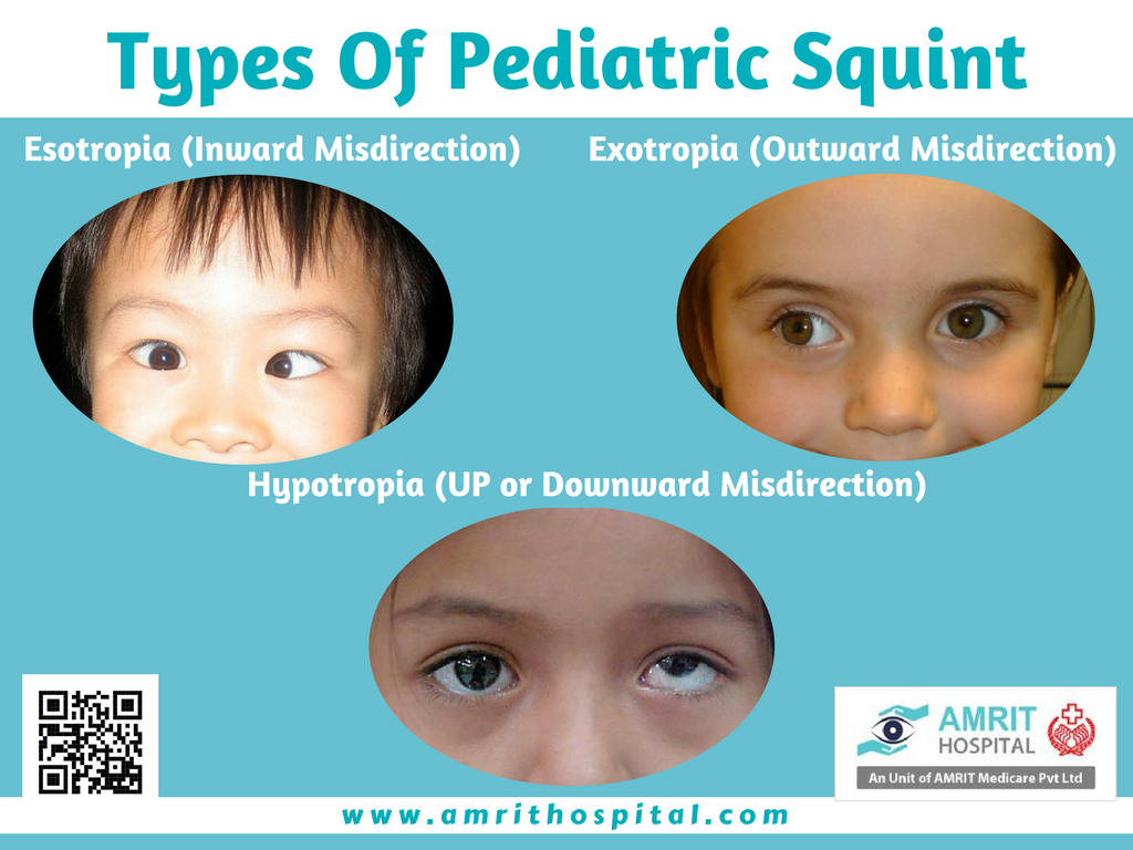 amrithospital's tweet photo. #SquintEye is a #disorder in which the #eyes don't look in exactly the same direction at the same time.Visit us @ https://t.co/gBOlJejc7B https://t.co/khHapFkmVK