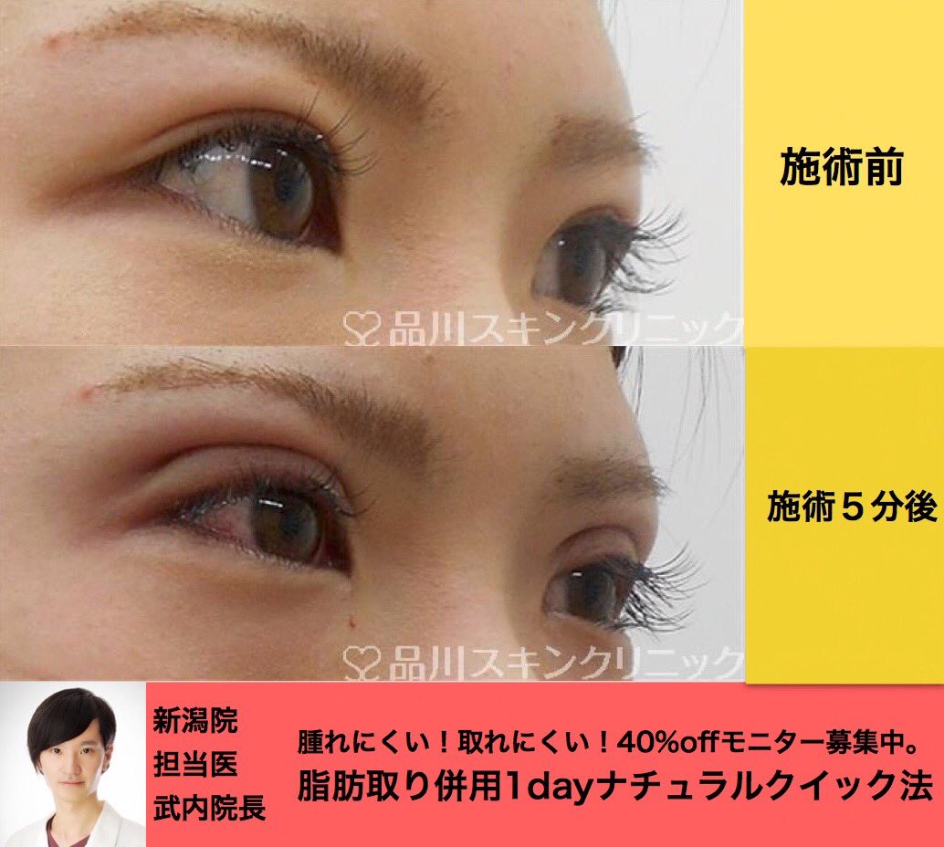 糸リフト 二重整形 鼻整形 ルラ美容クリニック院長 武内大 Ar Twitter 二重埋没法 1dayナチュラル法 上まぶたの脂肪取り 施術直後 腫れにくい 取りにくい 二重埋没法の1dayナチュラルクイック法の脂肪取り併用です 脂肪も取ってスッキリとした目元になってい 糸リフト 二重整形 鼻整形 ルラ美容クリニック院長 武内大 Ar Twitter 二重埋没法 1dayナチュラル法 上まぶたの脂肪取り 施術直後 腫れにくい 取りにくい 二重埋没法の1dayナチュラルクイック法の脂肪取り併用です 脂肪も取ってスッキリとした目元になってい