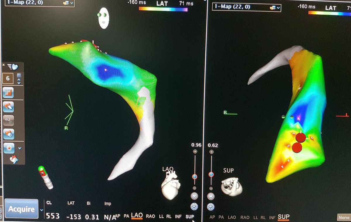 drnjy's tweet image. PVCs ablated from CS, thanks to @DrFerminGarcia @Dr_Santangeli for their paper and twitteaching!! Now planning CRT tomorrow!
