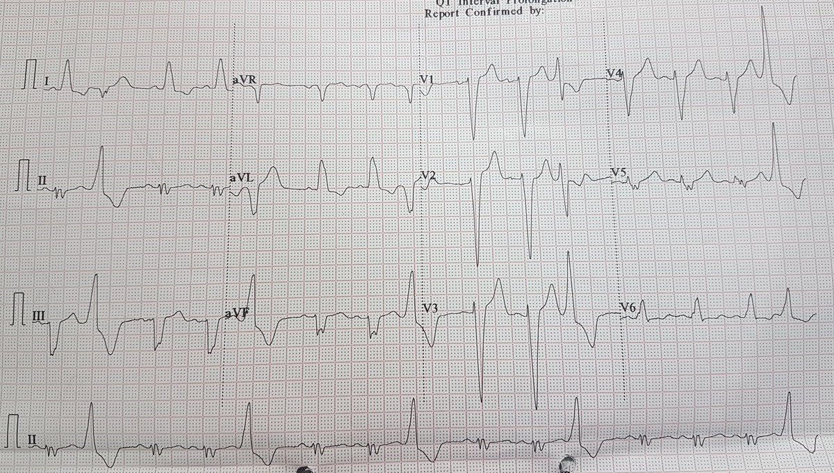 drnjy's tweet image. PVCs ablated from CS, thanks to @DrFerminGarcia @Dr_Santangeli for their paper and twitteaching!! Now planning CRT tomorrow!