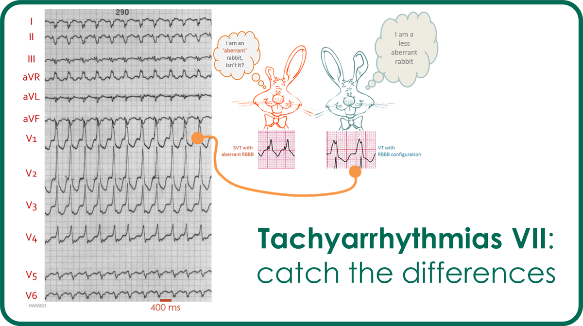 ECGcorner's tweet image. ecgcorner.org/mod/lesson/vie…
New lesson @ECGcorner:Tachyarrhythmias VII
#electrocardiography #Cardiology #ECG #FOAMed #meded #tachyarrhythmias