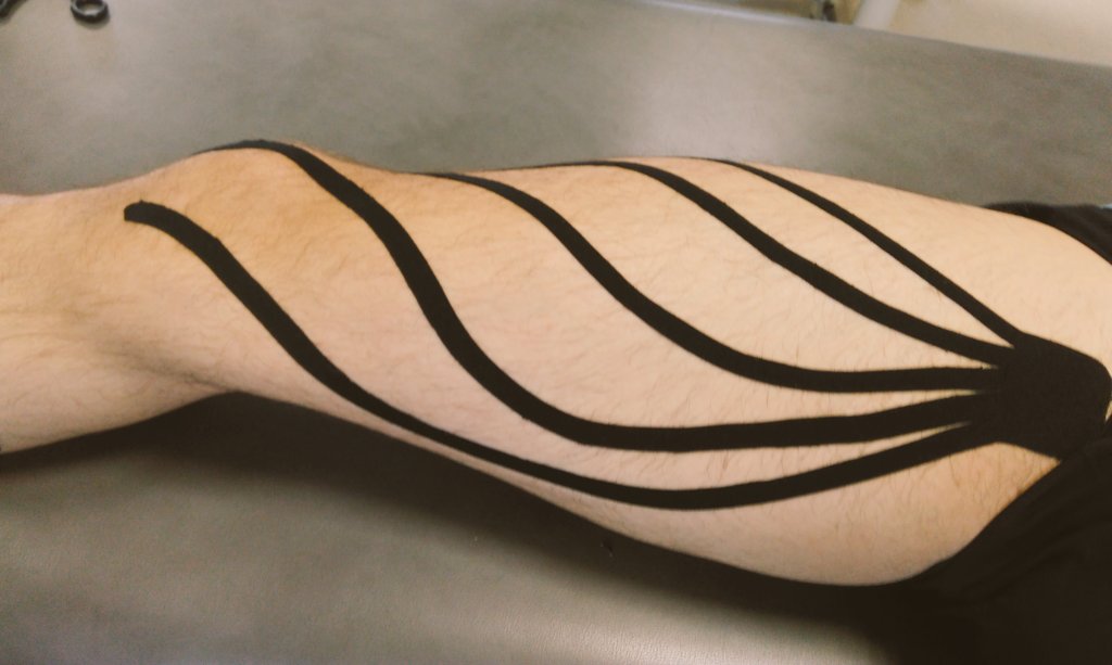 Fisio_Lain's tweet photo. Seguimos con el kinesiotaping! Esta vez drenaje linfático para inflamación o edema! 🔝🔝🐙🐙 https://t.co/GSEUnqokRe