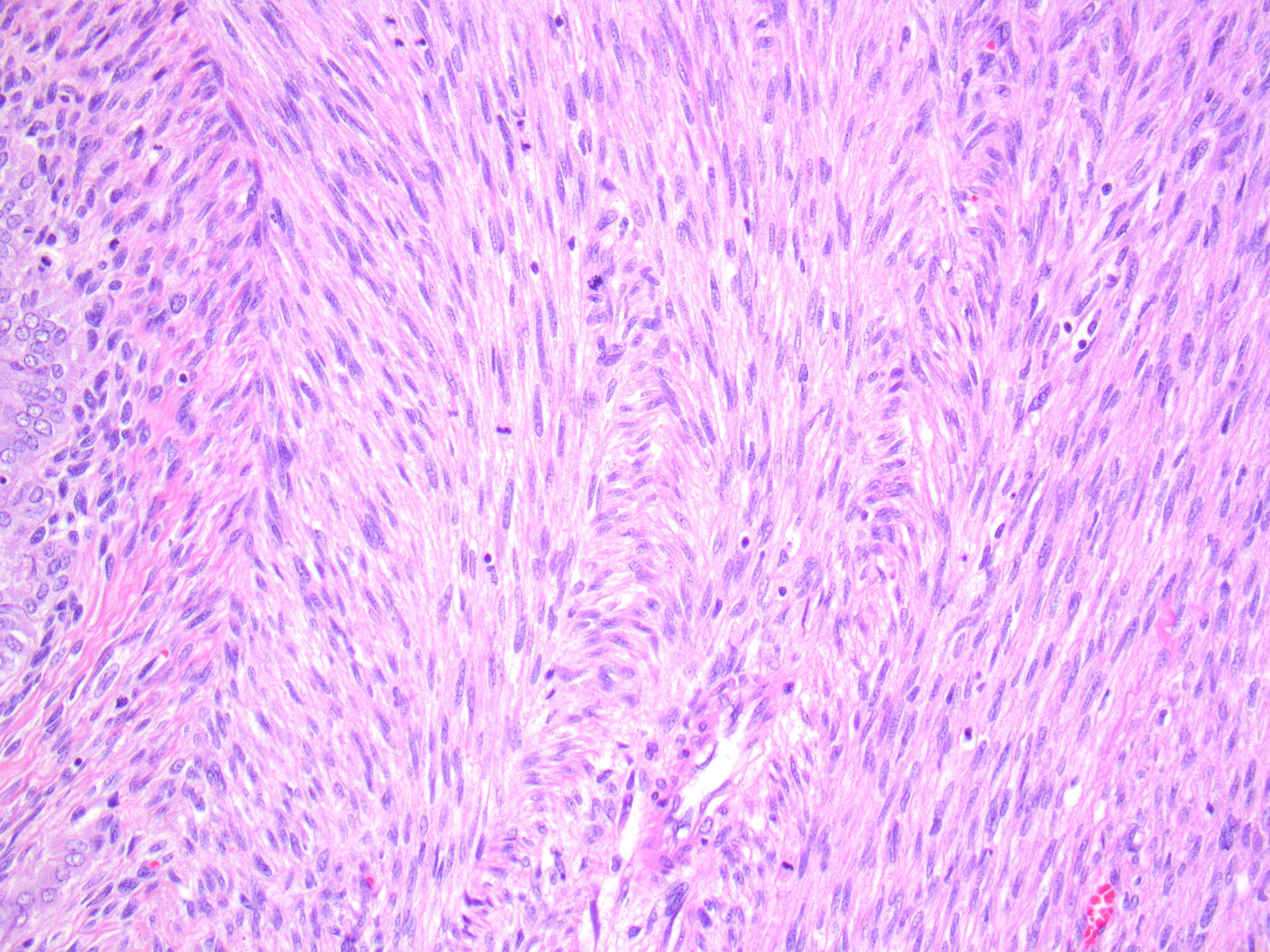 Brendan Dickson, MD on Twitter "MÜLLERIAN FISH MDM2. NB