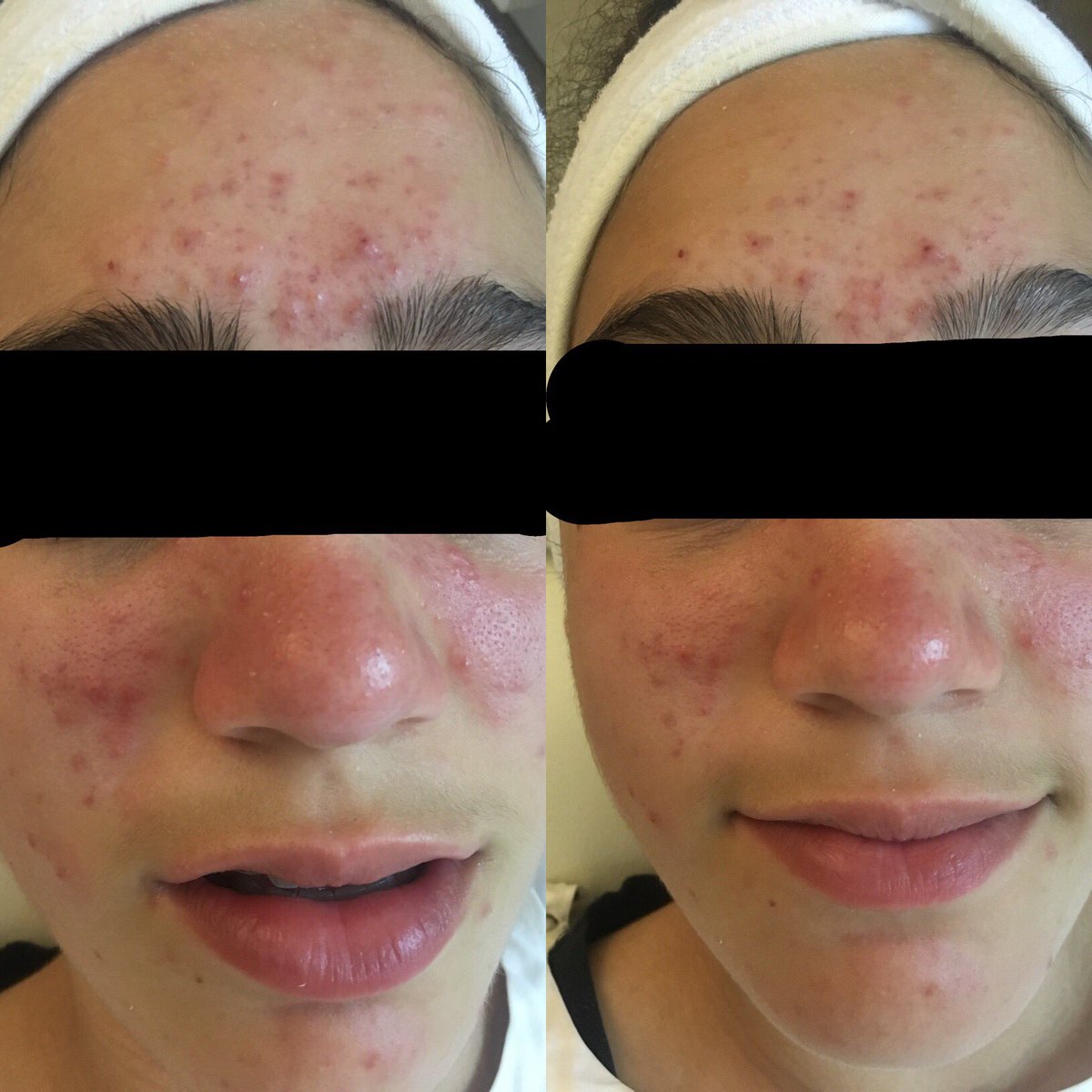 Still haven't tried the LED <a href="/LightStim/">LightStim</a>? This is proof what just one 20 min session can do for your #imflammation #ledlighttherapy   #acne