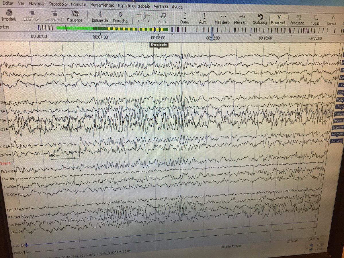 Realizamos #EEG #Electroencefalograma
