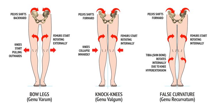 niramayacare's tweet photo. TODAY top 5 topics about your body, Bow Legs - How To Straighten Your Legs! #OrthopedicsCentre #OrthopedicDoctor https://t.co/EjBNn7H725 https://t.co/ZT6SgSPC7u