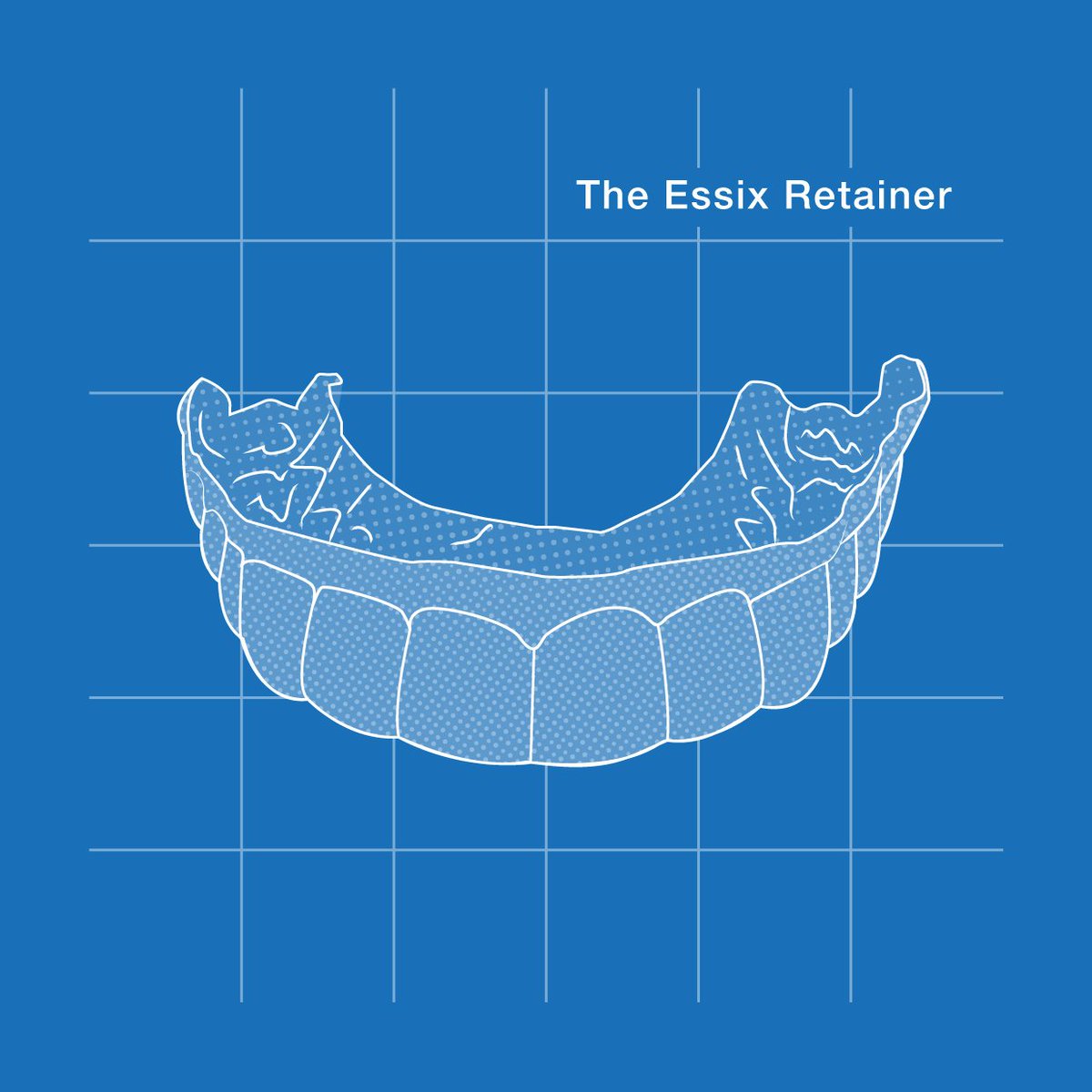 BellinghamSCSC's tweet image. THE #ESSIX #RETAINER looks more like an #Invisalign tray than a #traditional #retainer, and is made of #thin , #t...