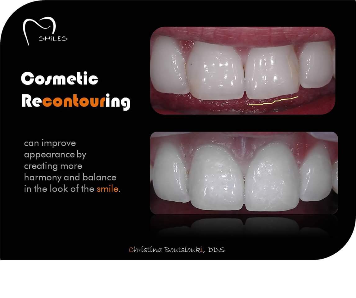 Smiles_Odontiat's tweet photo. #cosmetic #recontouring
Αλλαγές στο περίγραμμα των #δοντιών
🔷https://t.co/ixtdgg2tl6🔷
#smilesstories #odontsmiles #thessaloniki #odontiatros https://t.co/qlrKV5OZbr